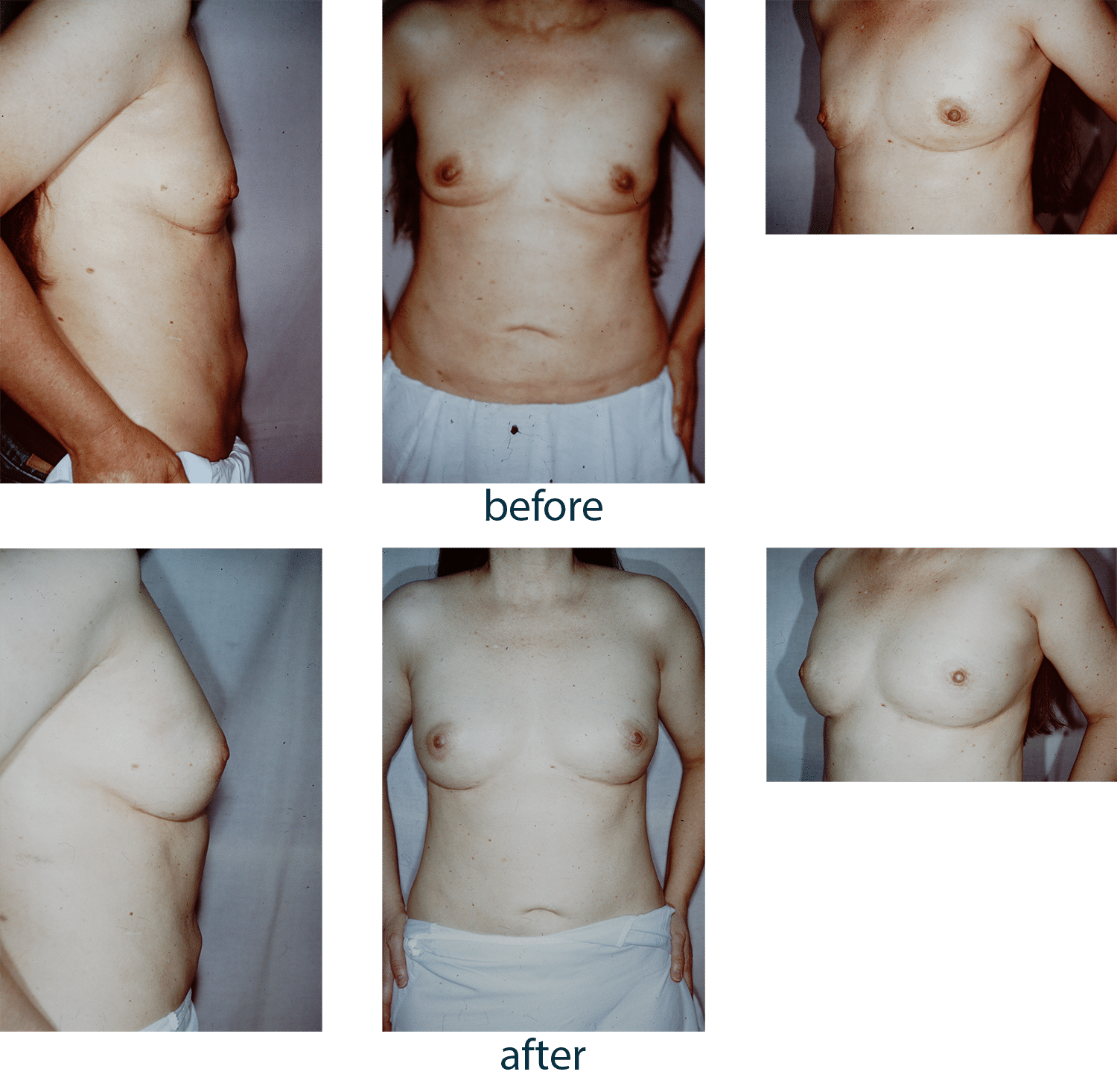 Nipple-sparing mastectomy followed by fat injection grafting