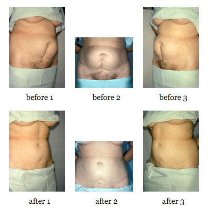 Tummy tuck surgery, Apron belly removal, Prices